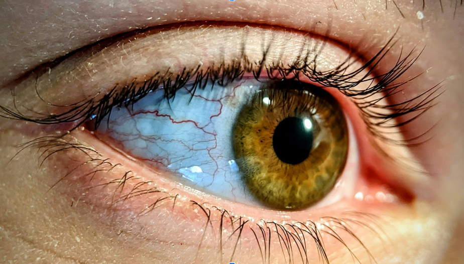 Cocaine Eyes: What They Are and Why You Shouldn't Ignore Them